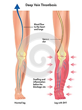 Deep vein thrombosis photo