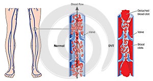 Deep vein thrombosis