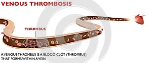 Deep vein thrombosis