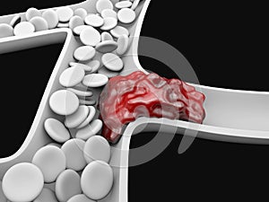 Deep Vein Thrombosis or Blood Clots. Embolism.