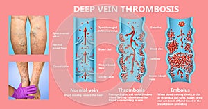 Deep Vein Thrombosis or Blood Clots. Embolus.