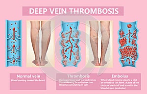 Deep Vein Thrombosis or Blood Clots. Embolus.