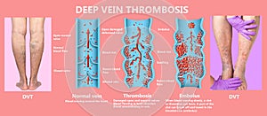 Deep Vein Thrombosis or Blood Clots. Embolus.