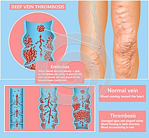 Deep Vein Thrombosis or Blood Clots. Embolus.