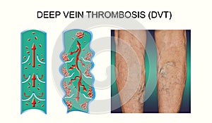 Deep Vein Thrombosis or Blood Clots. Embolus.