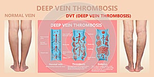 Deep Vein Thrombosis or Blood Clots. Embolus. photo