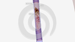 Deep vein thrombosis complications 3d