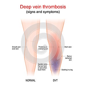 Deep vein thrombosis. Healthy leg, and leg with DVT. Sign and symptoms