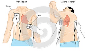 Defibrillator cardioversion