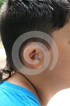 Deformation of the ear. Irregular shape of the auricle.
