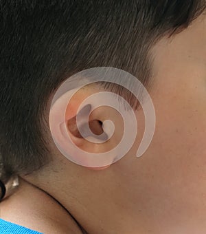 Deformation of the ear. Irregular shape of the auricle. photo