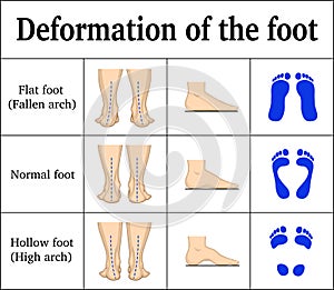 Deformation of the foot