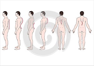 Deformation of the spineÃÂ 