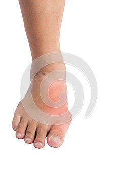 Deformed foot with gout inflammation