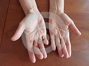 Deformed hands photo