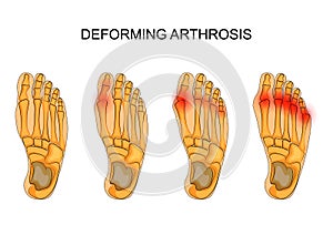 Deforming arthrosis of the foot