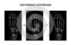 Deforming arthrosis of the foot