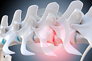 Degenerated intervertebral disc of the dog spine