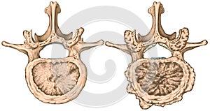 Degenerative changes vertebra