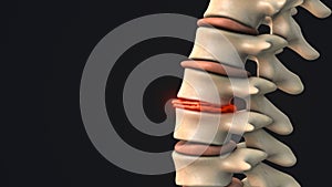 Degenerative disc in the human spine photo