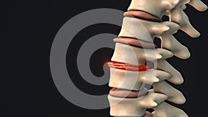 Degenerative disc in the human spine