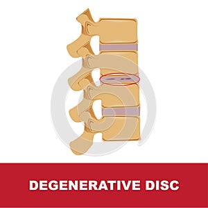 Degenerative disc illustration photo