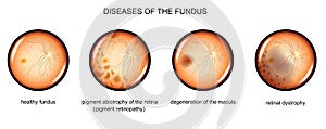 Degenerative diseases of the fundus