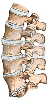 Degenerative lumbar disc disease