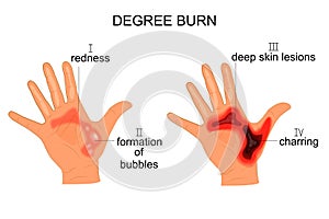 Degree burn