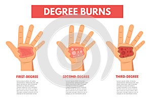Degree burns of skin. Infographic