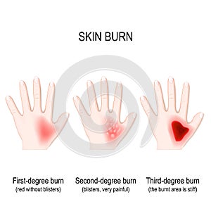 Degree burns of skin. step of burn