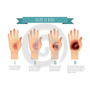 Degree of skin burns. Flat vector illustration for websites, brochures, magazines etc