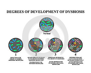 4 degrees of development of dysbiosis. Dysbacteriosis of the intestine. large intestine. dysbiosis of colon. Bacteria, fungi. photo