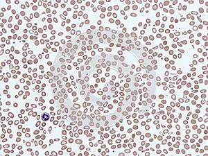 Delta beta thalassemia.