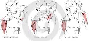 Deltoids pain cause by myofascial triggger points.