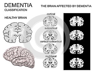 Dementia, Alzheimer's disease