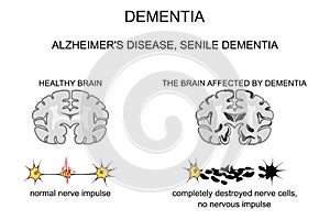 Dementia, Alzheimer s disease. pathogenesis