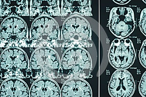 Dementia brain on MRI