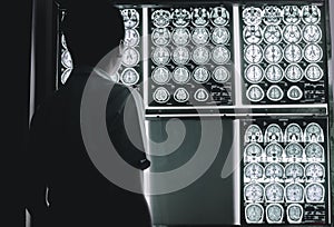 Dementia brain on MRI photo