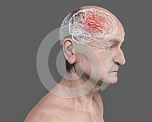 Dementia, conceptual illustration showing an elderly person with progressive impairments of brain functions