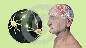 Dementia, conceptual illustration showing an elderly person with progressive impairments of brain functions, distruction of photo