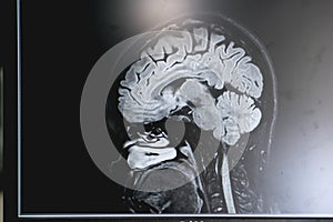 Dementia on MRI film. brain dementia.