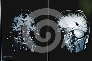 Dementia on MRI film. brain dementia.