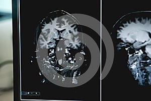 Dementia on MRI film. brain dementia.