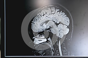 Dementia on MRI film. brain dementia. photo
