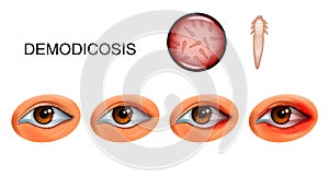 Demodecosis. tick Demodex on eyelashes