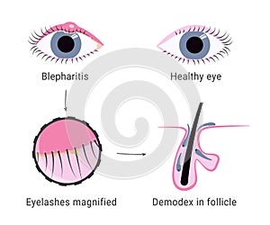 Demodex infection causing blepharitis. Eyelash mites microscope view. Demodex mite in hair follicles of eyelashes photo