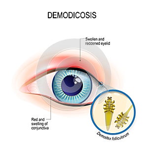 Demodicosis of eyelid and red eyes. Close-up demodex through mag photo