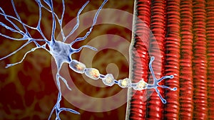 Demyelination of a neuron, the damage of the neuron myelin sheath seen in demyelinating diseases