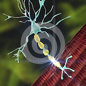 Demyelination of a neuron, the damage of the neuron myelin sheath seen in demyelinating diseases